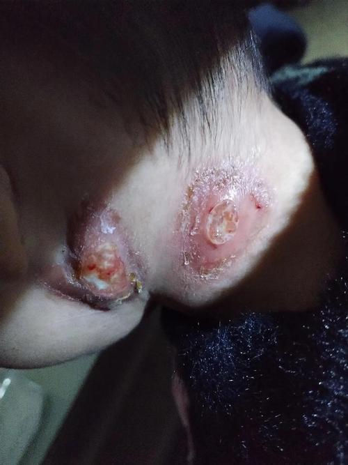 淋巴结核能治好吗 淋巴结核能治好吗