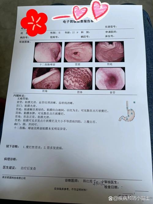 糜烂性胃炎多久会癌变? 糜烂性胃炎多久会癌变?