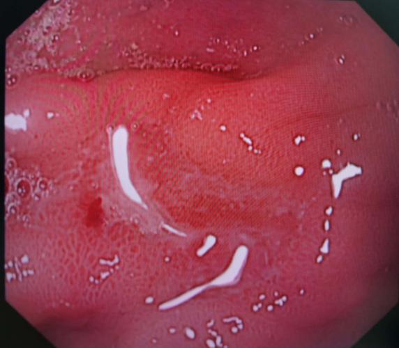糜烂性胃炎多久会癌变? 糜烂性胃炎多久会癌变?