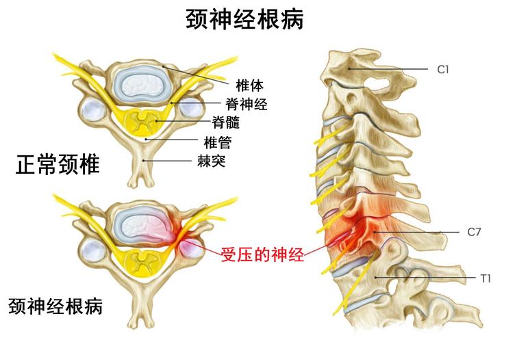 神经根型颈椎病吃什么药