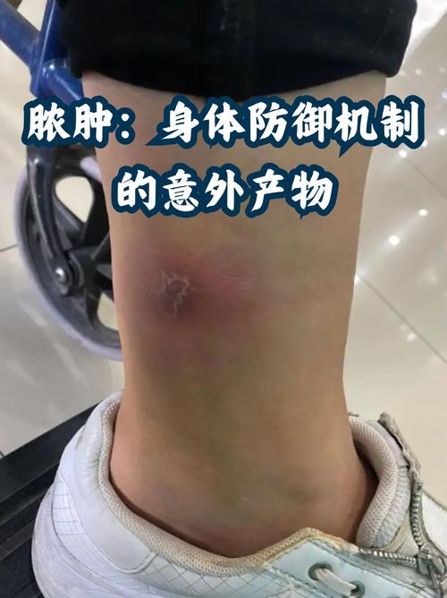 肛周脓肿切开引流后多久能好