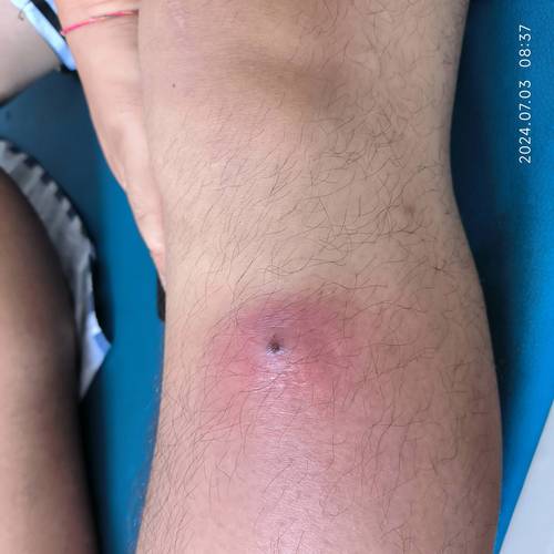 肛周脓肿切开引流后多久能好