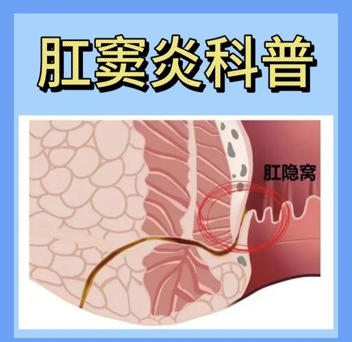 肛窦炎用什么药最好 肛窦炎用什么药最好