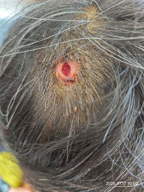 治甲沟炎该怎么办 治甲沟炎该怎么办