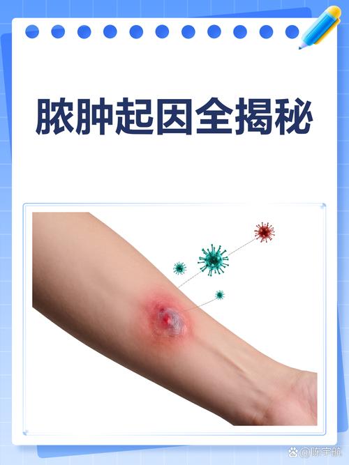 治甲沟炎该怎么办 治甲沟炎该怎么办