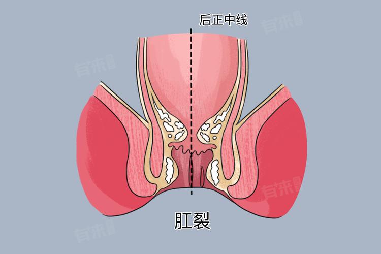 红霉素软膏可以让肛裂伤口愈合吗? 红霉素软膏可以让肛裂伤口愈合吗?