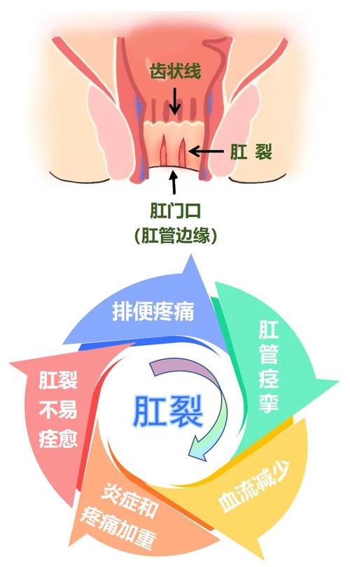 红霉素软膏可以让肛裂伤口愈合吗? 红霉素软膏可以让肛裂伤口愈合吗?