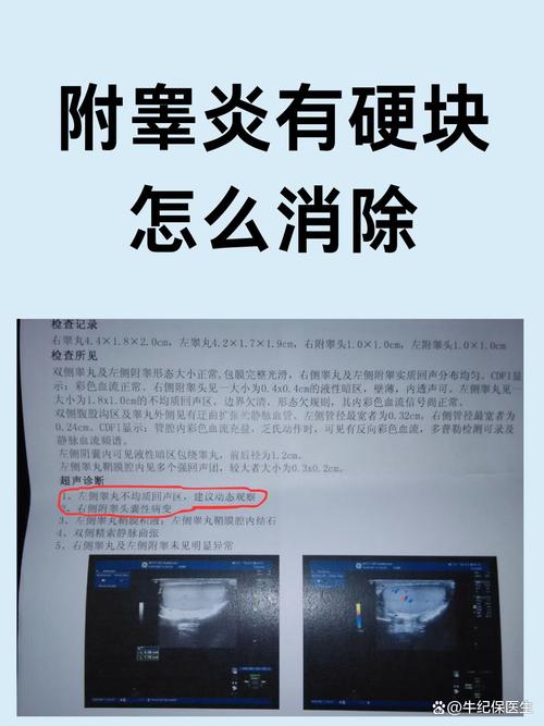 附睾丸炎的硬块多久能消除 附睾丸炎的硬块多久能消除