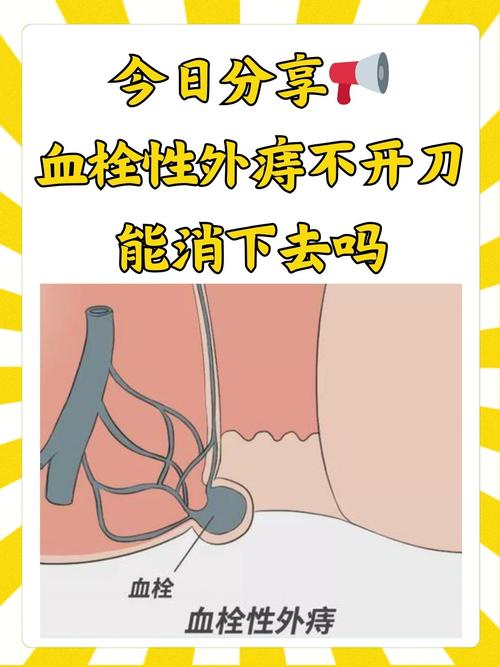 痣疮用什么药效果最好 痣疮用什么药效果最好