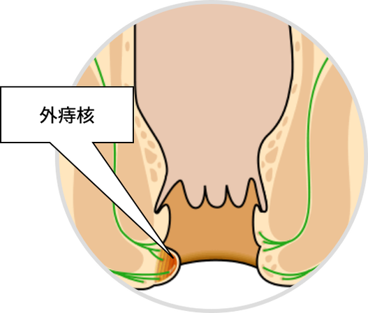 痔疮的痔核是什么