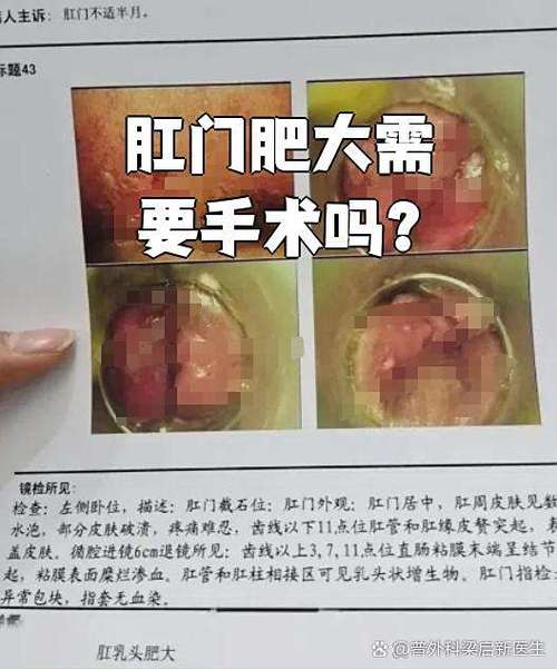 肛乳头长在什么位置