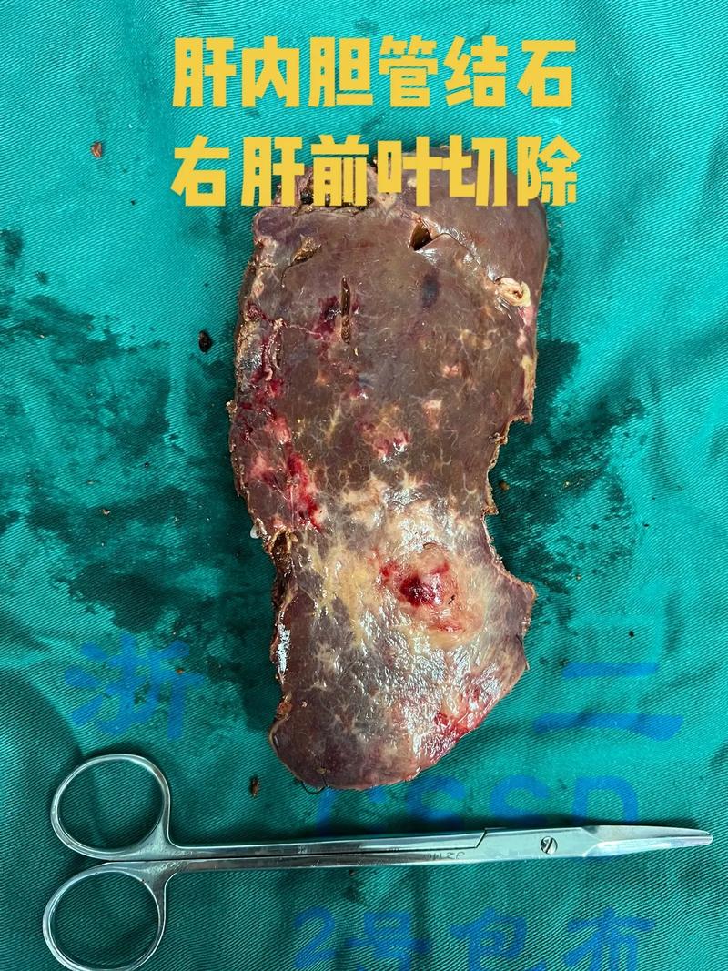 肝内胆管结石多大需要治疗 肝内胆管结石多大需要治疗