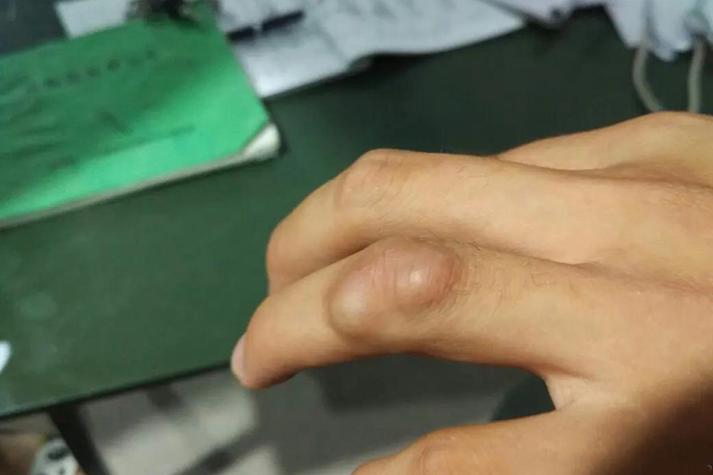 手背腱鞘囊肿怎么治? 手背腱鞘囊肿怎么治?