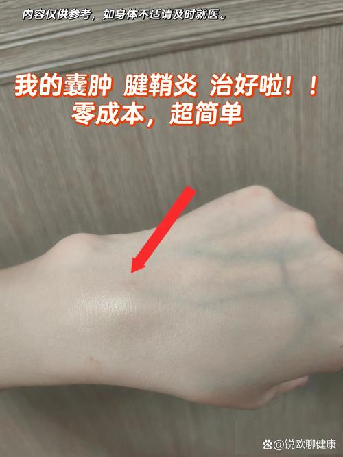 手背腱鞘囊肿怎么治? 手背腱鞘囊肿怎么治?