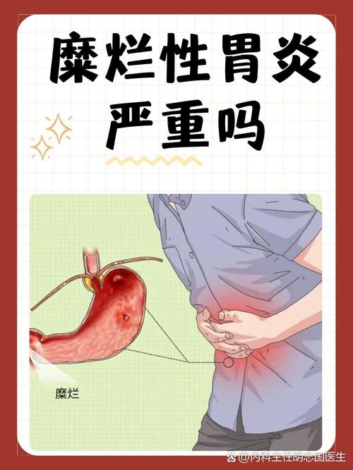 糜烂性胃炎是怎么发生的 糜烂性胃炎是怎么发生的