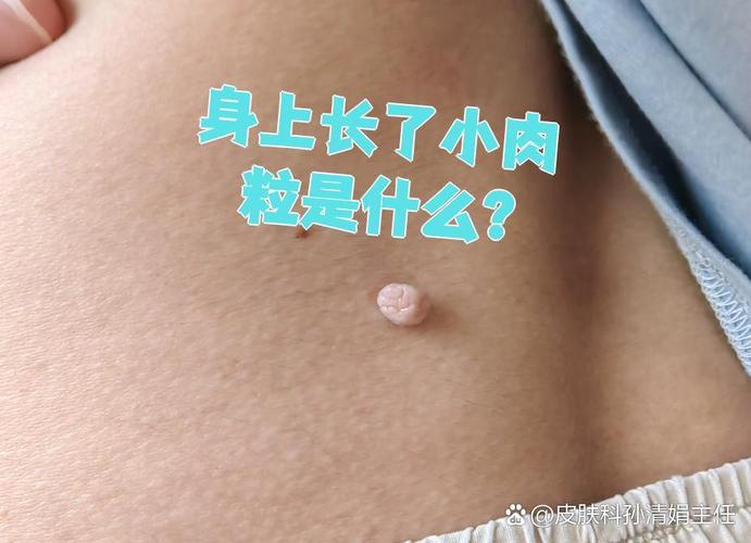 如何区分皮赘和丝状疣?