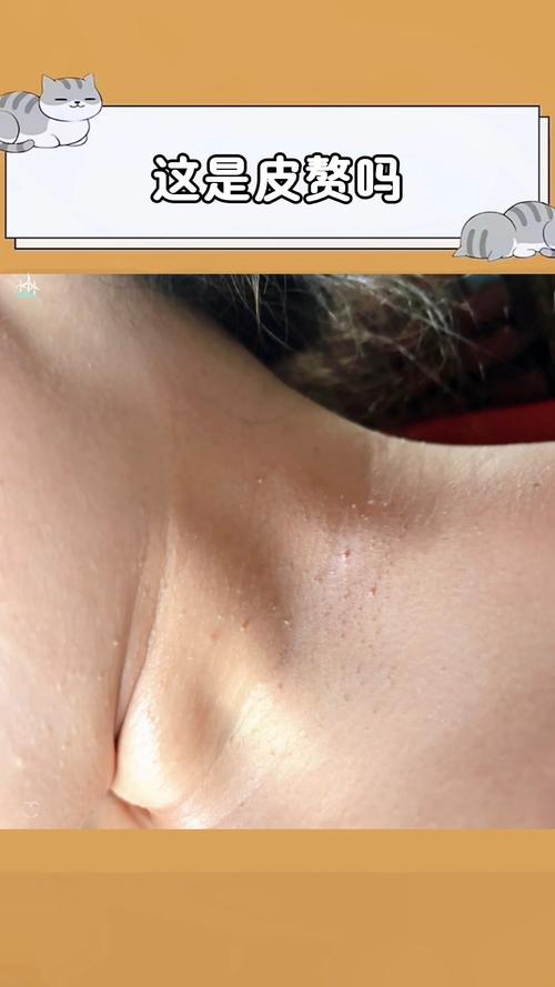 如何区分皮赘和丝状疣?