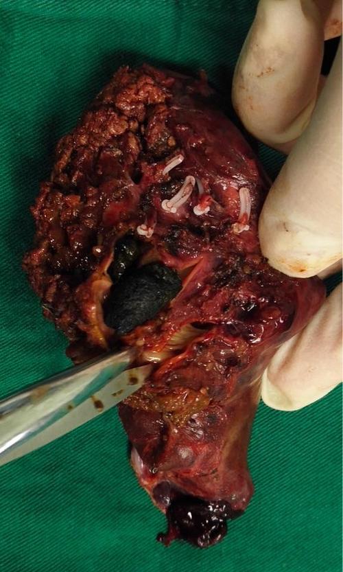 肝内胆管结石会引起哪些不适的症状