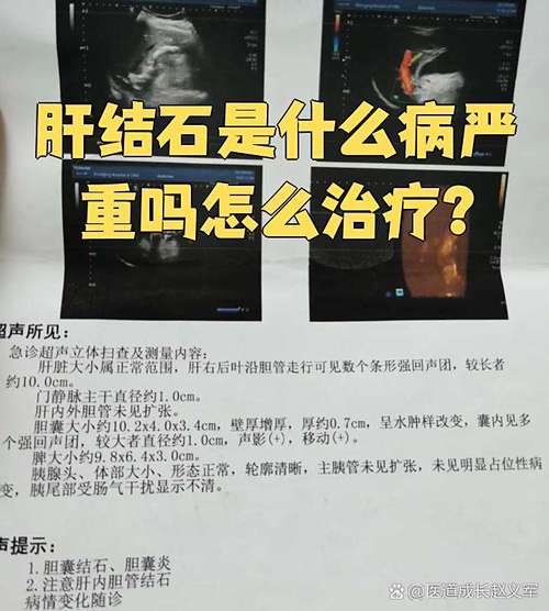 肝内胆管结石会引起哪些不适的症状