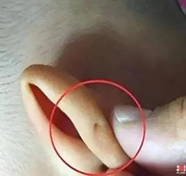 鳃裂瘘管是大手术吗