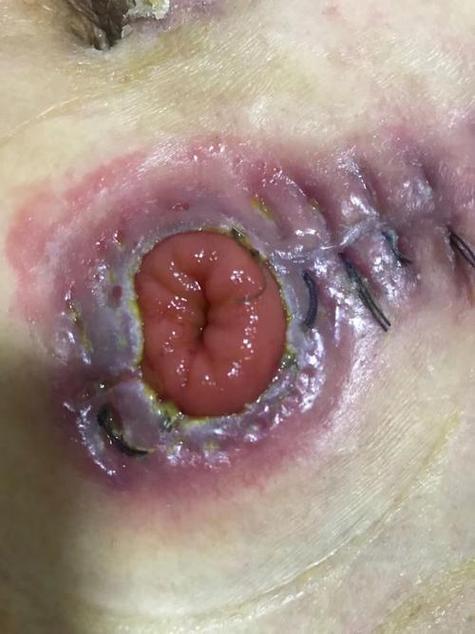 鳃裂瘘管是大手术吗