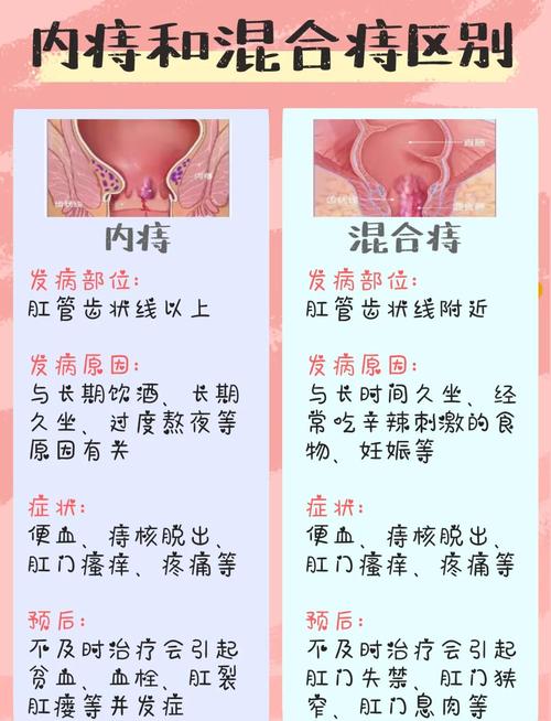 痔疮人群比例 痔疮人群比例