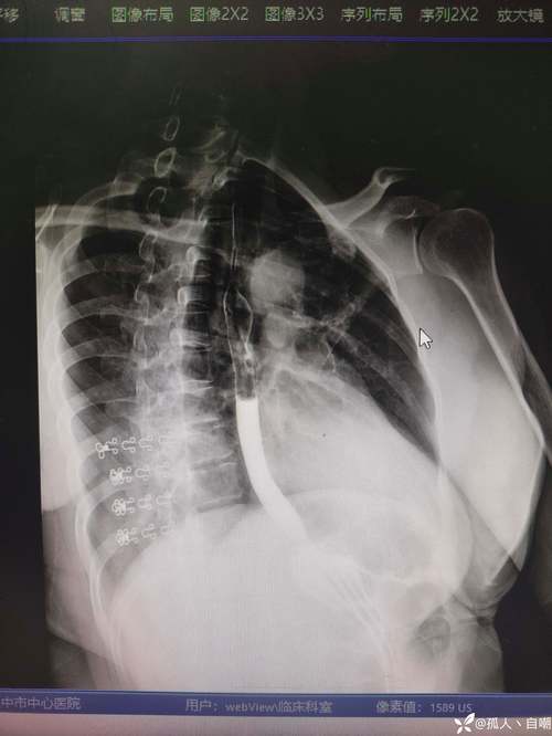 食管的三个狭窄 食管的三个狭窄