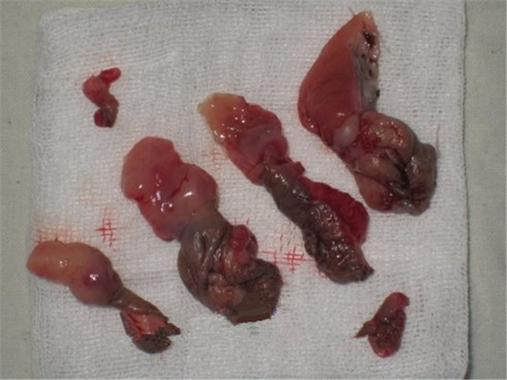 血栓痔疮和痔疮的区别