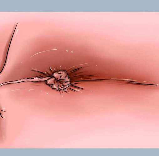 痔疮肉球脱出收不回一定要手术吗 痔疮肉球脱出收不回一定要手术吗