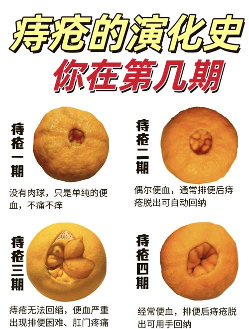 痔疮肉球脱出收不回一定要手术吗 痔疮肉球脱出收不回一定要手术吗