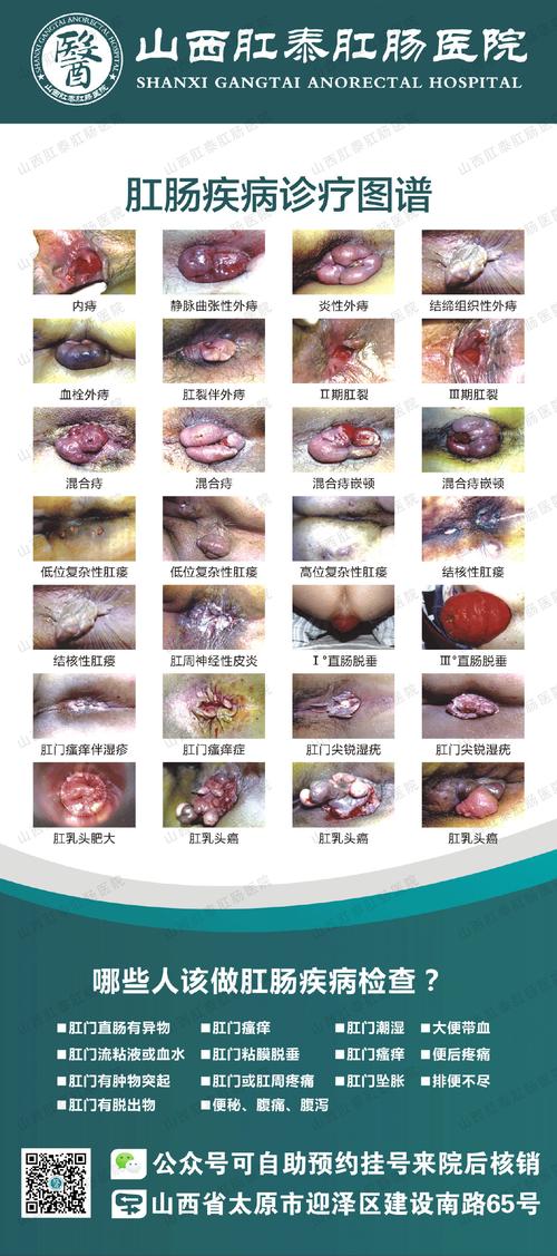 静脉曲张性外痔可以消失吗 静脉曲张性外痔可以消失吗