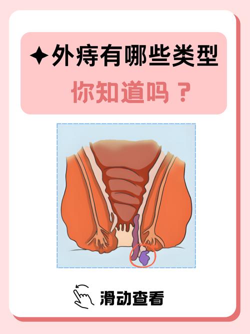 静脉曲张性外痔可以消失吗 静脉曲张性外痔可以消失吗