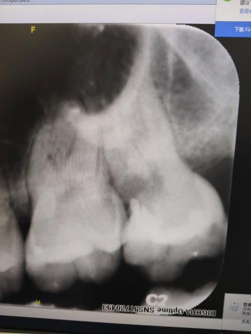 急性牙髓炎是怎么样的 急性牙髓炎是怎么样的