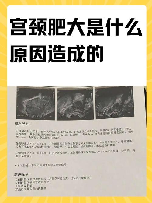 宫颈肥大是什么原因造成