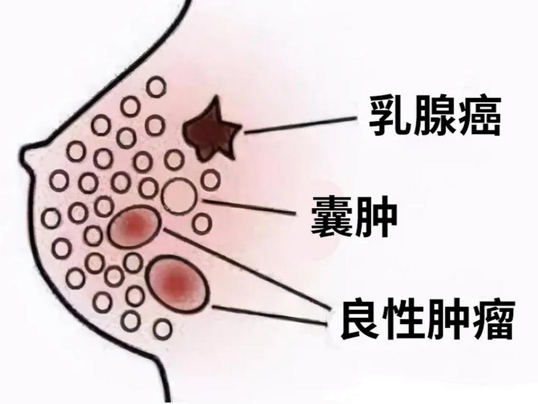 乳腺增生肿块怎么消除 乳腺增生肿块怎么消除