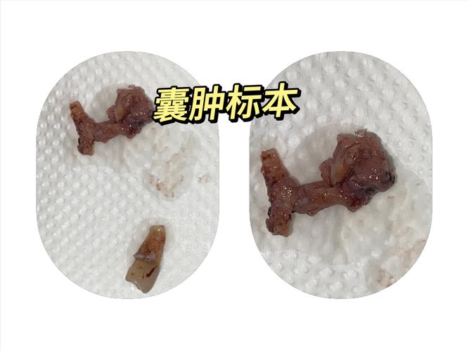 肿瘤和囊肿的区别